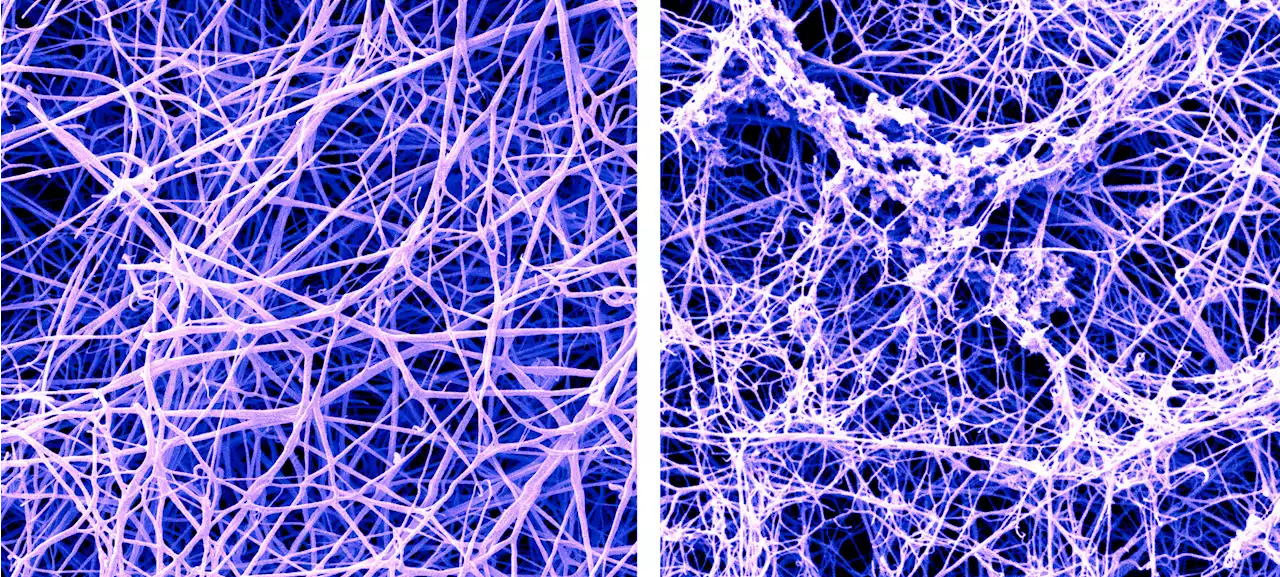 Unlocking how the new Alzheimer's drug lecanemab works