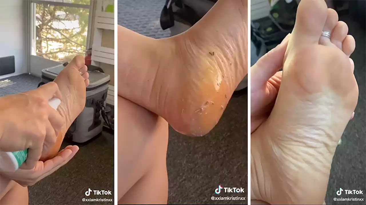 Shoppers Swear This $5 Viral Foot Peeling Spray ‘Instantly’ Removes Dead Skin