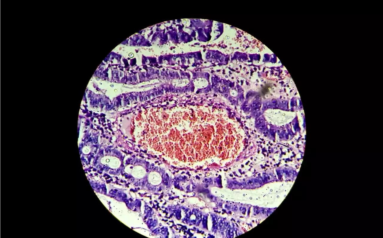 Cáncer: llegan las bacterias capaces de detectar si se está desarrollando un tumor y aniquilarlo