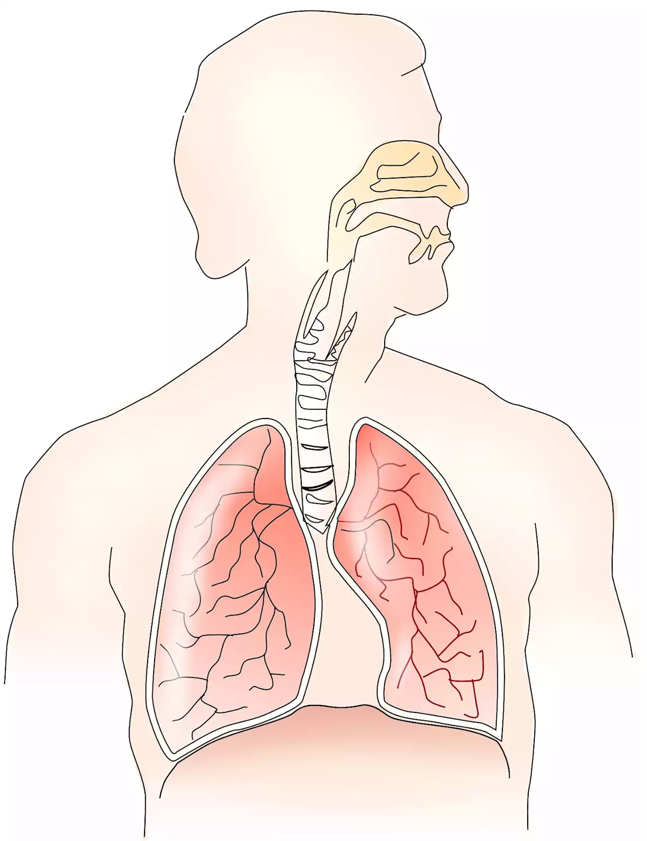 Exhaled breath analysis shows promise in detecting malignant pleural mesothelioma