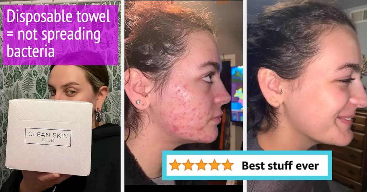 If You Have Acne-Prone Skin, Here Are 23 Products Reviewers Actually Swear By