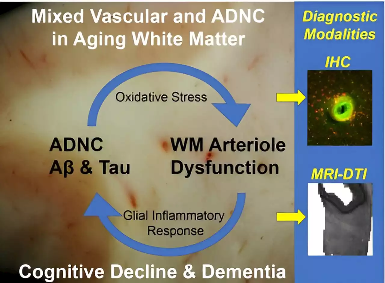 Study reports on contributions to white matter injury in Alzheimer's disease