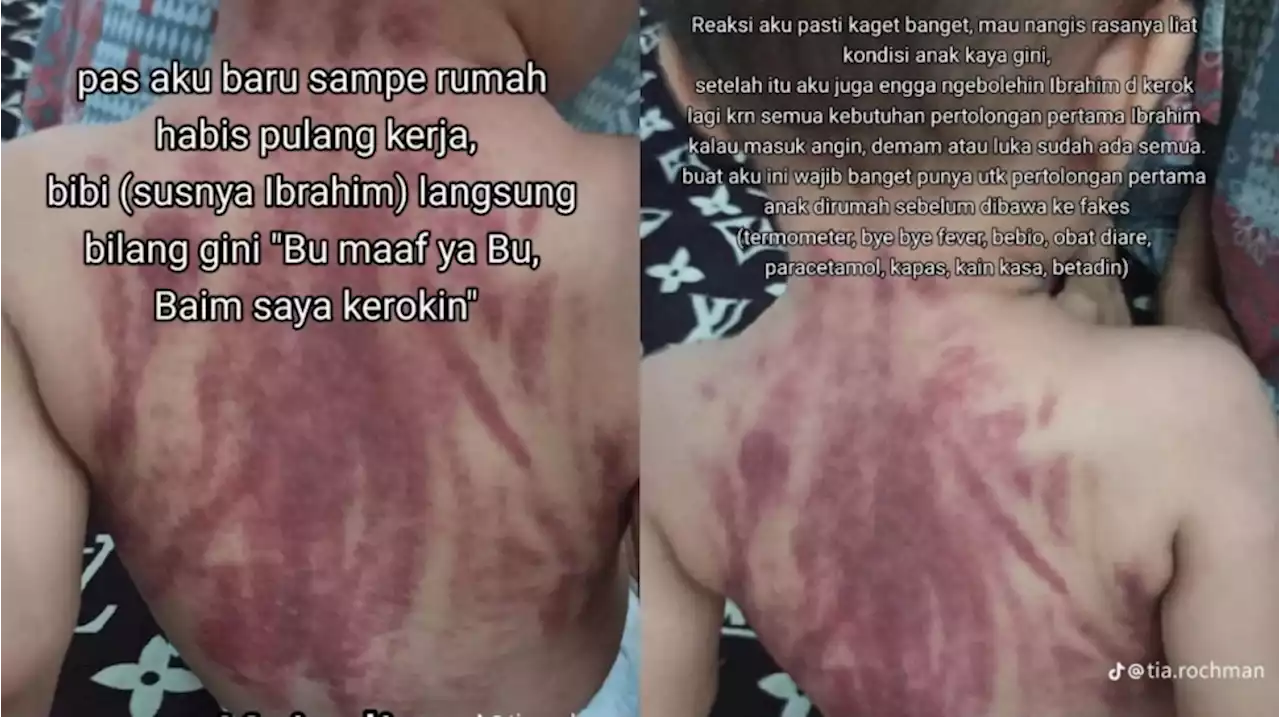 Viral Bayi Nangis Kejer karena Dikerok Pengasuh Hingga Punggungnya Memerah, Ketahui Bahayanya