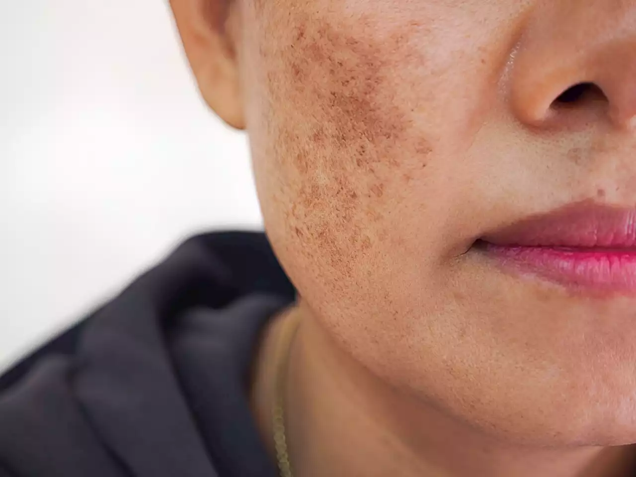 Melasma: New dark patches or freckling—A dermatologist offers tips on dealing with it