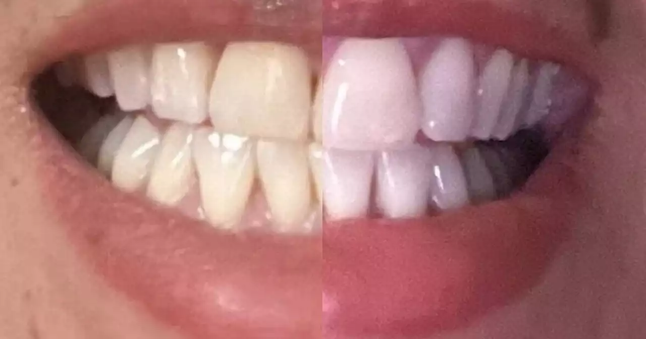 'My coffee stained teeth are shades whiter thanks to £19 Amazon teeth whitener'