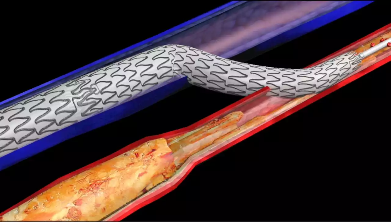 Technique to spare diabetic amputations pioneered at UH receives FDA approval