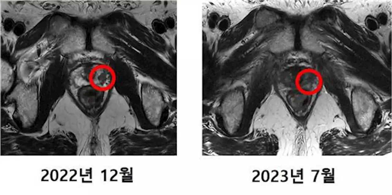 한 달 만에 암 조직 사라지고 주변 장기 피해 없어… 3,000억 원 들인 ‘꿈의 암 치료기’ 성공