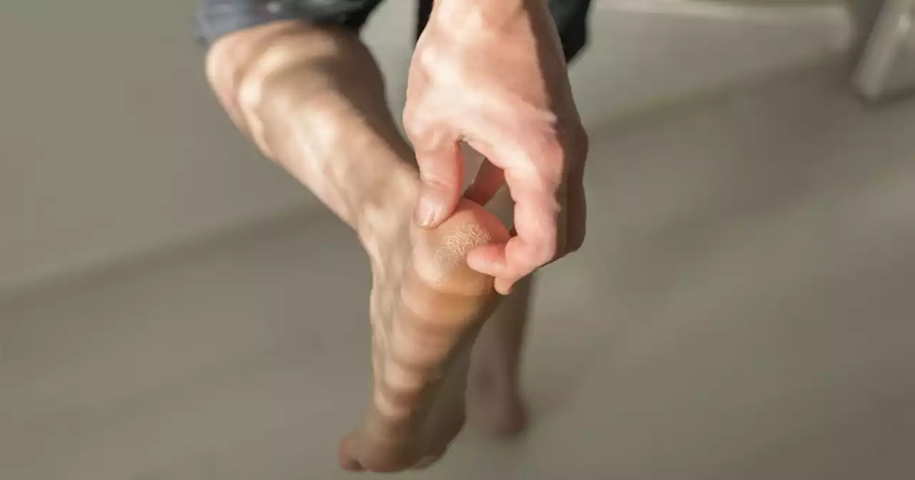 Check Your Feet For Signs Of These Serious Conditions, Warns Pharmacist