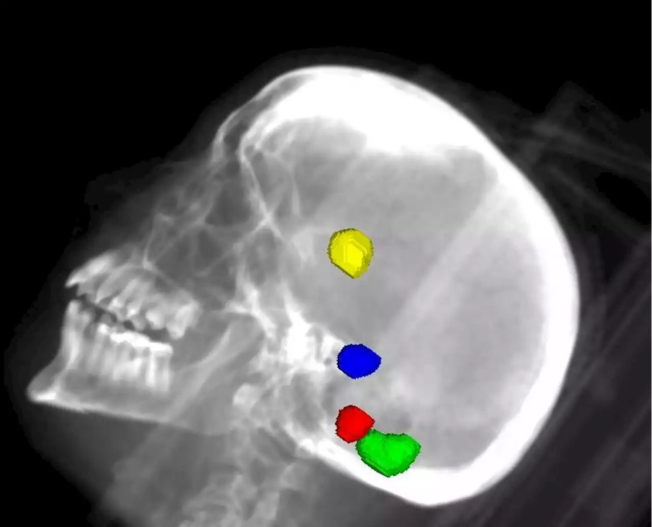 Gegen Metastasen im Gehirn: Neue Methode am Caritas-Klinikum Saarbrücken – 17 von 20 Krebs-Patienten erfolgreich therapiert