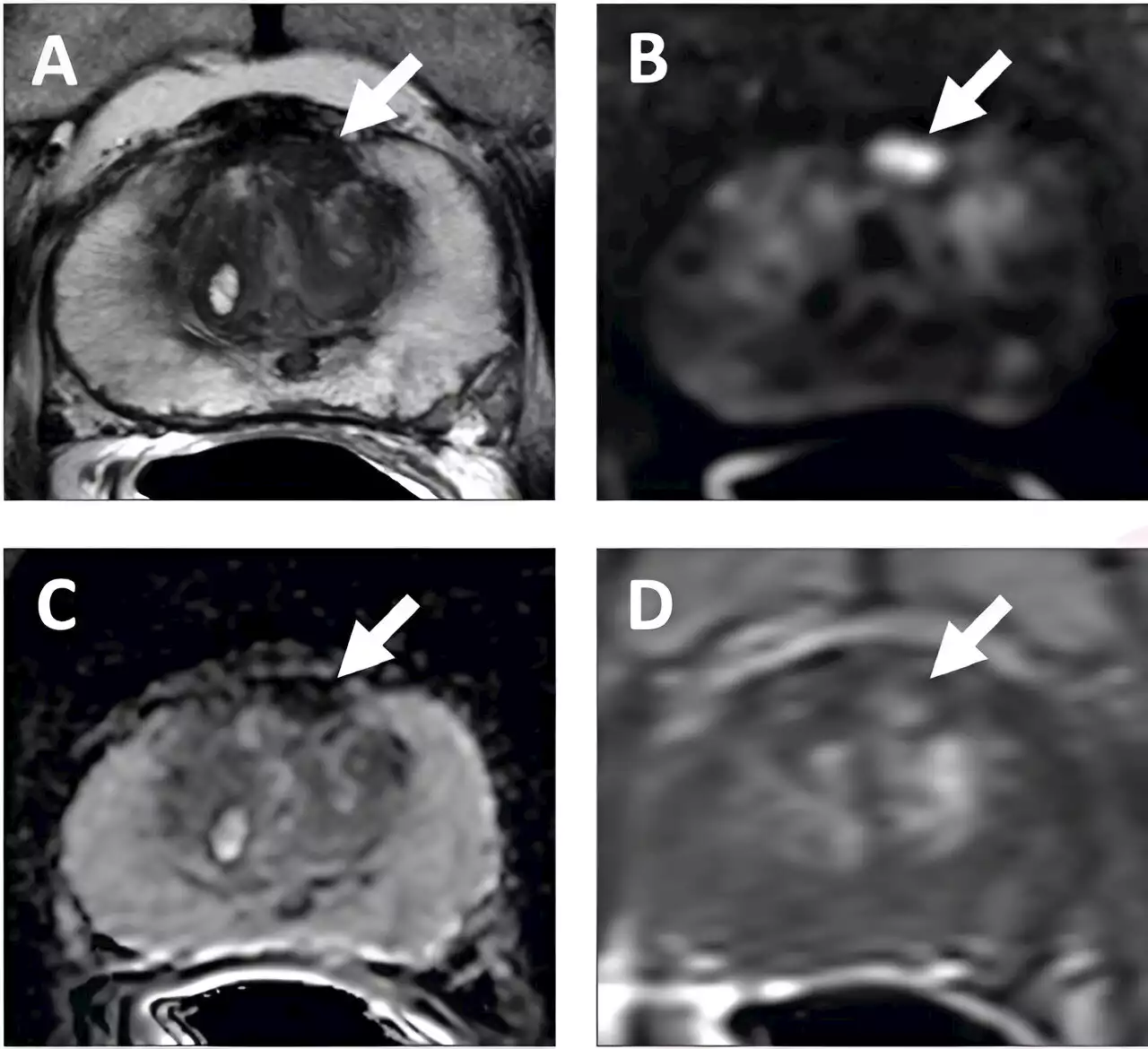 Prostate cancer upgrade, downgrade rates in PI-RADS 2.0 versus 2.1