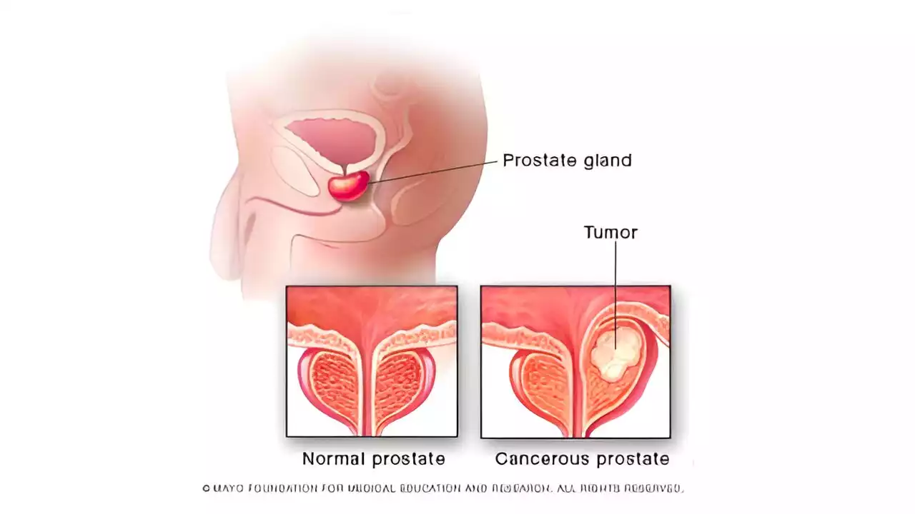 Video: What Black men need to know about prostate cancer