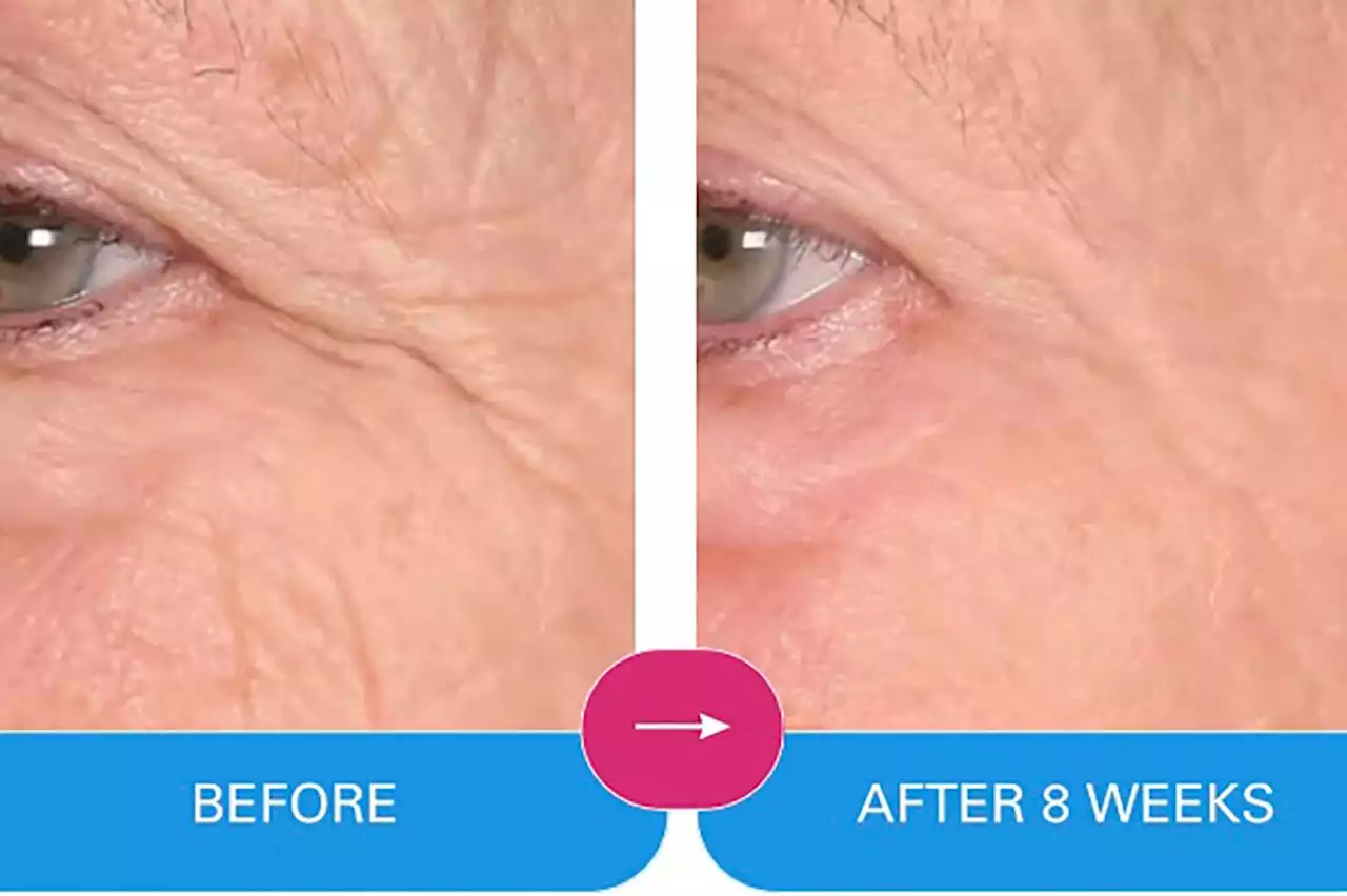 This Wrinkle Treatment Delivers Remarkable Anti-Aging Results