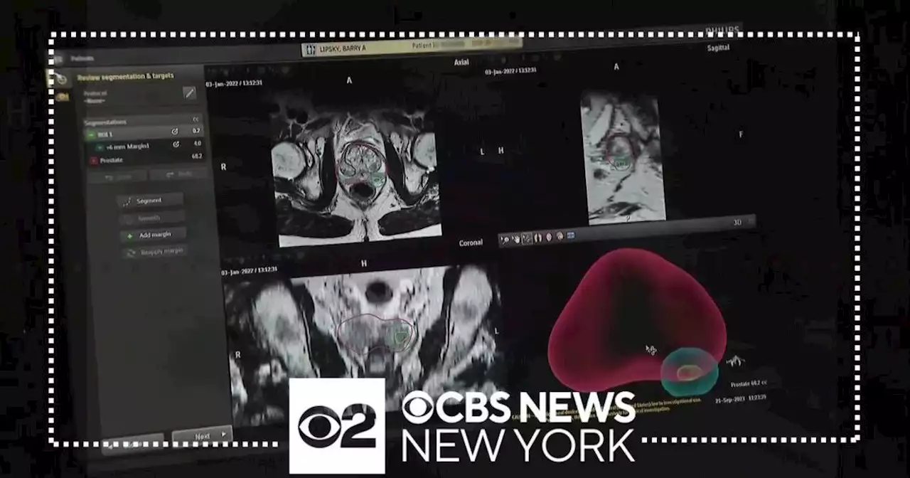 CBS New York's exclusive look at new treatments to fight prostate cancer