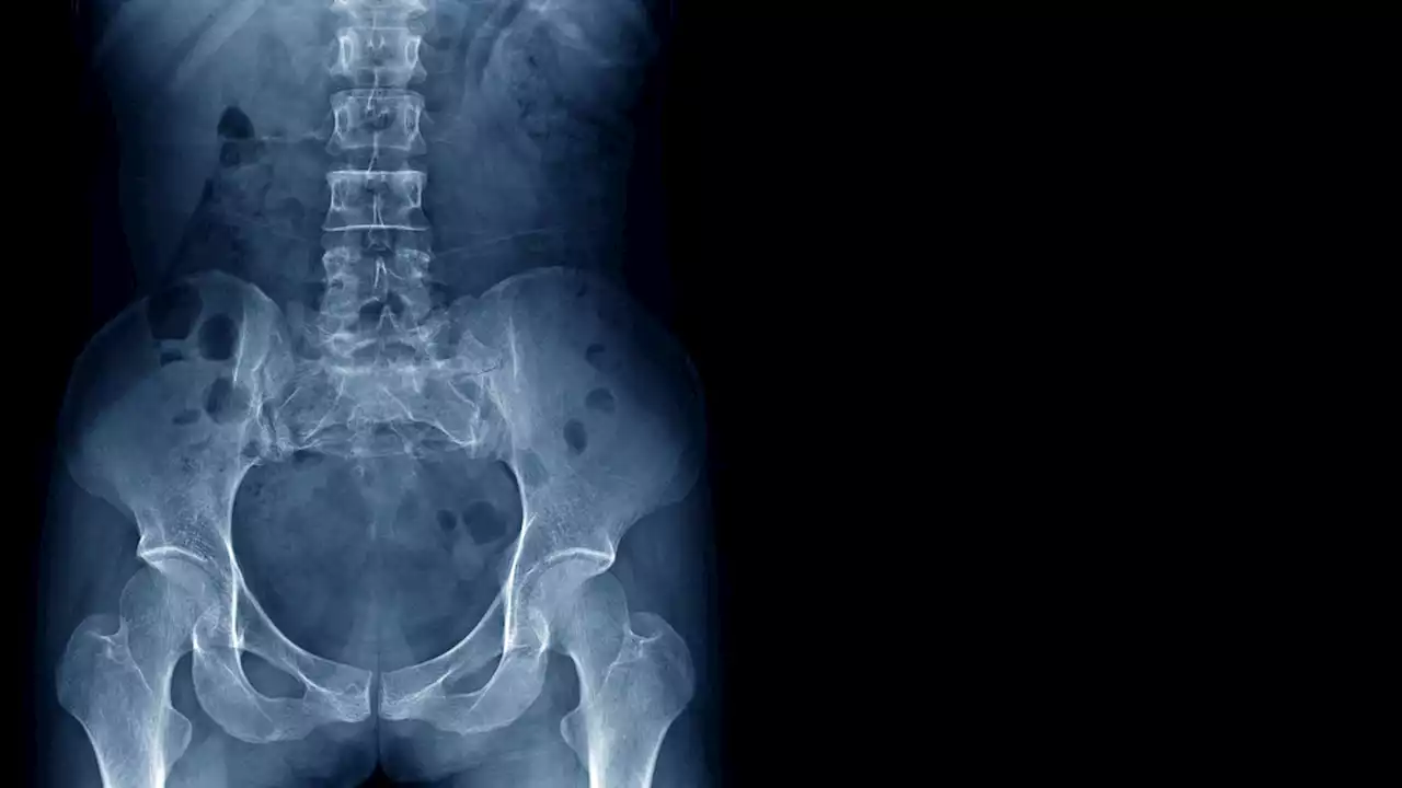 An Experimental Drug May Help Prevent Bone Loss in Space