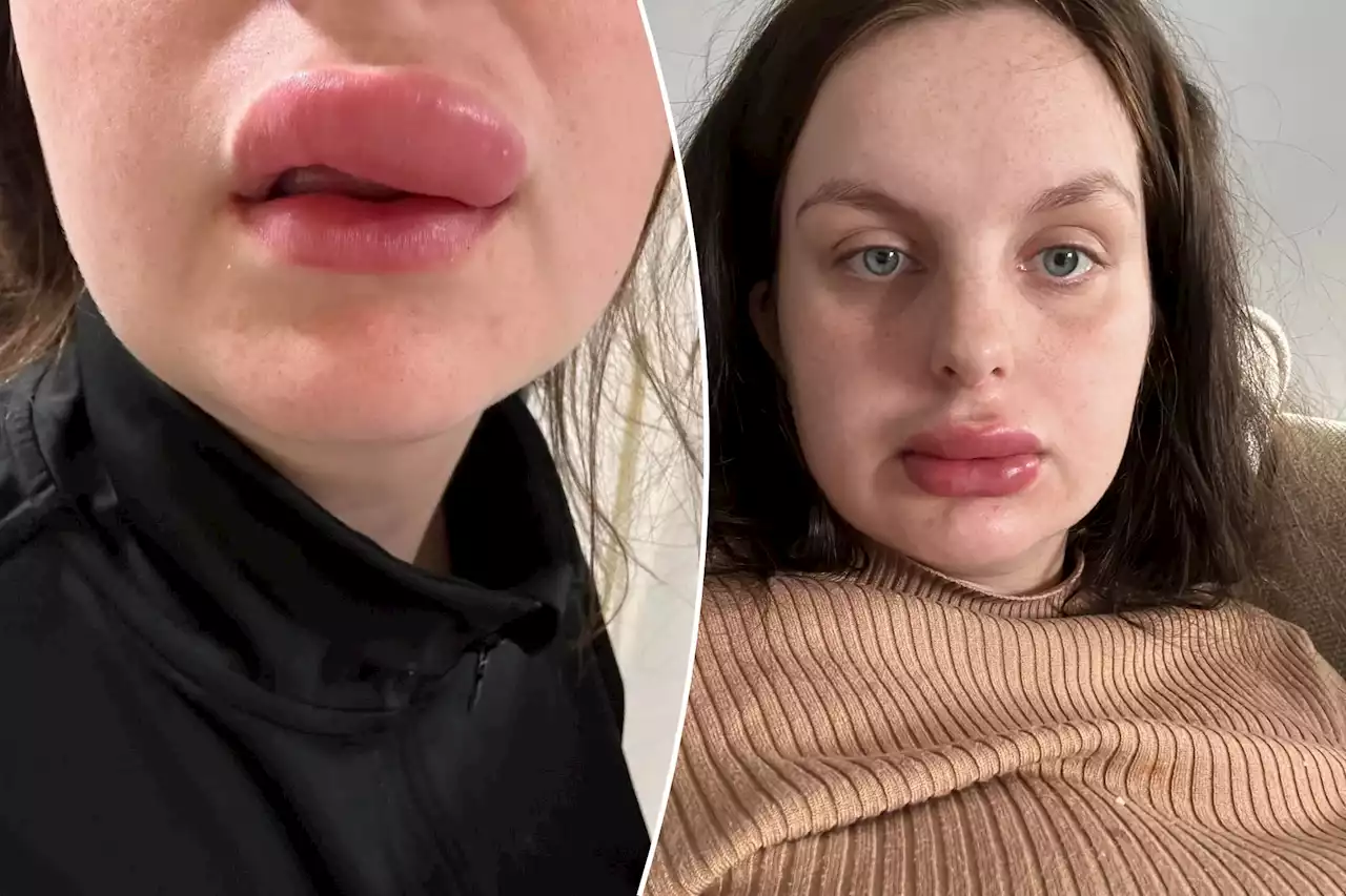 I won a $12 lip filler raffle — it went red-hot wrong