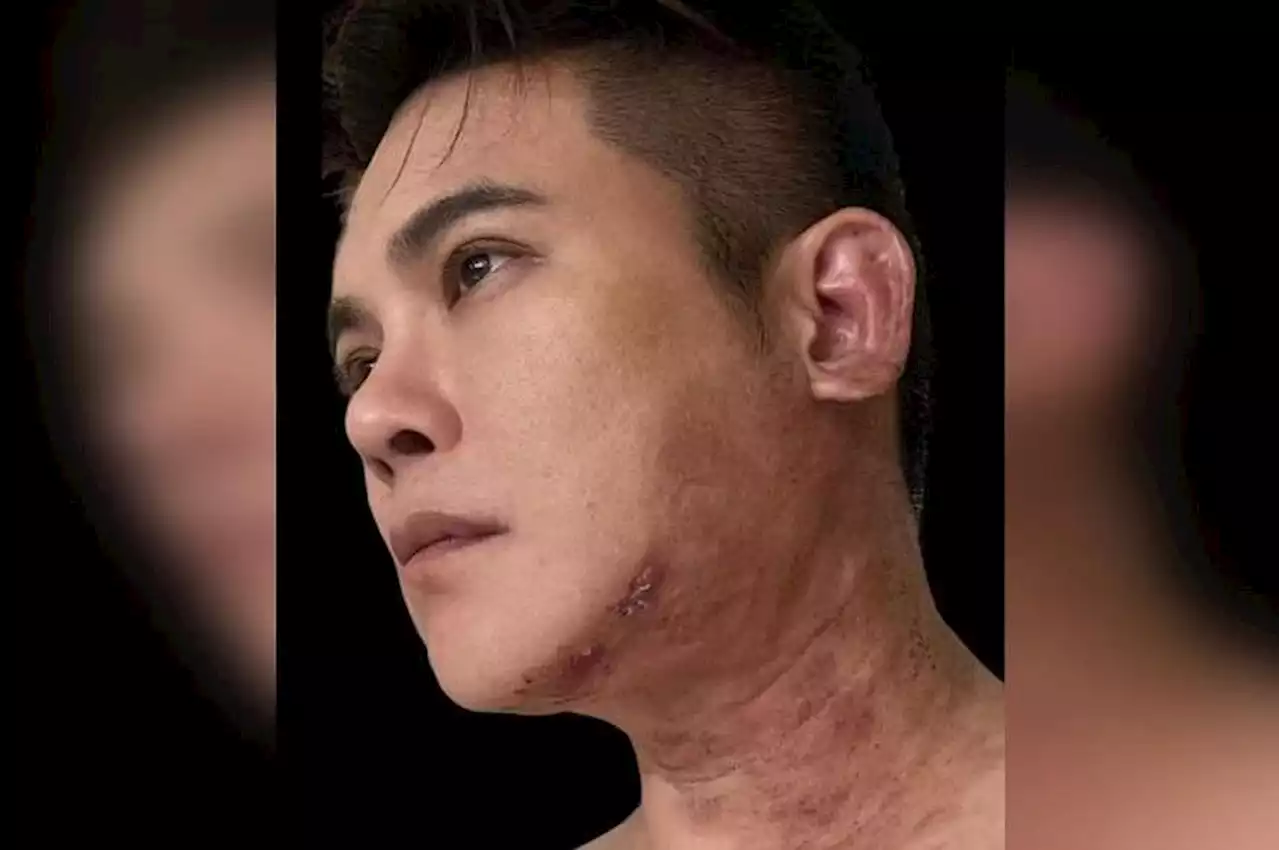 Singaporean actor Nick Shen shares his painful experience of battling shingles