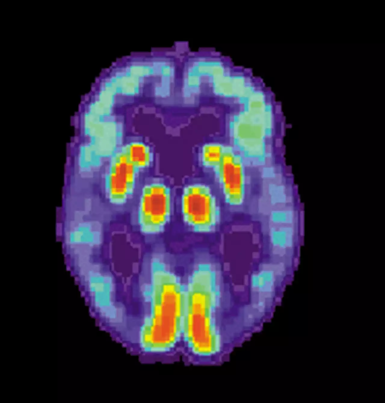 Team presents new approach to discover targets for Alzheimer's, other diseases with protein phase separation