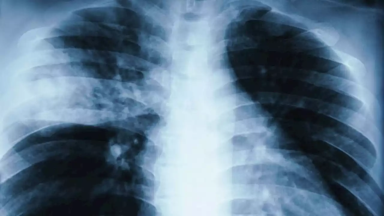 Pneumonia, Not Just Inflammation, May Cause Severe COVID