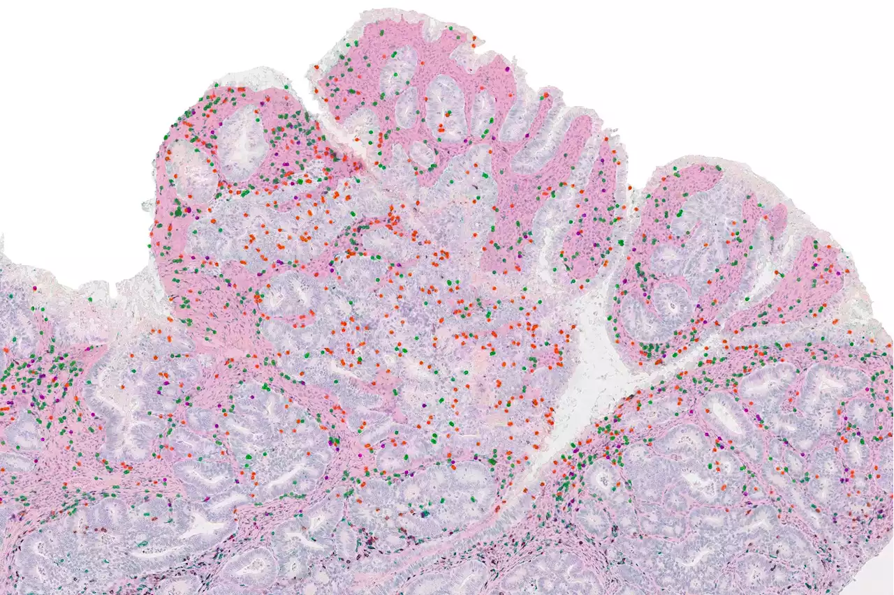 Mutation Mix-Up: Why Some Immunotherapies for Cancer Don’t Always Work As Predicted