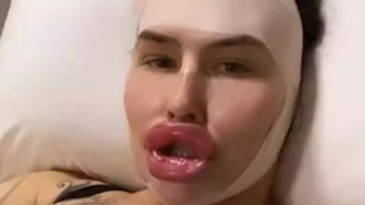 Horror-Lippen von Influencerin schocken das Netz