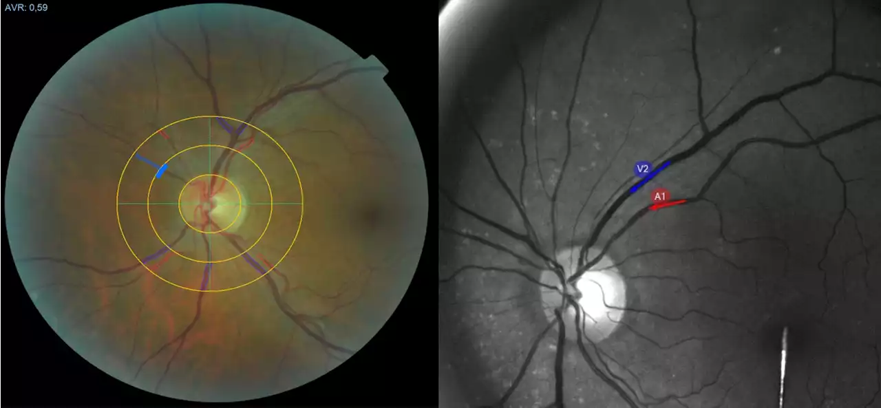 Eyes Don’t Lie: Unlocking Long COVID Secrets Through Blood Vessels in the Eye