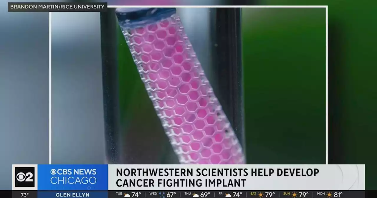 Northwestern scientists developing cancer-fighting implant