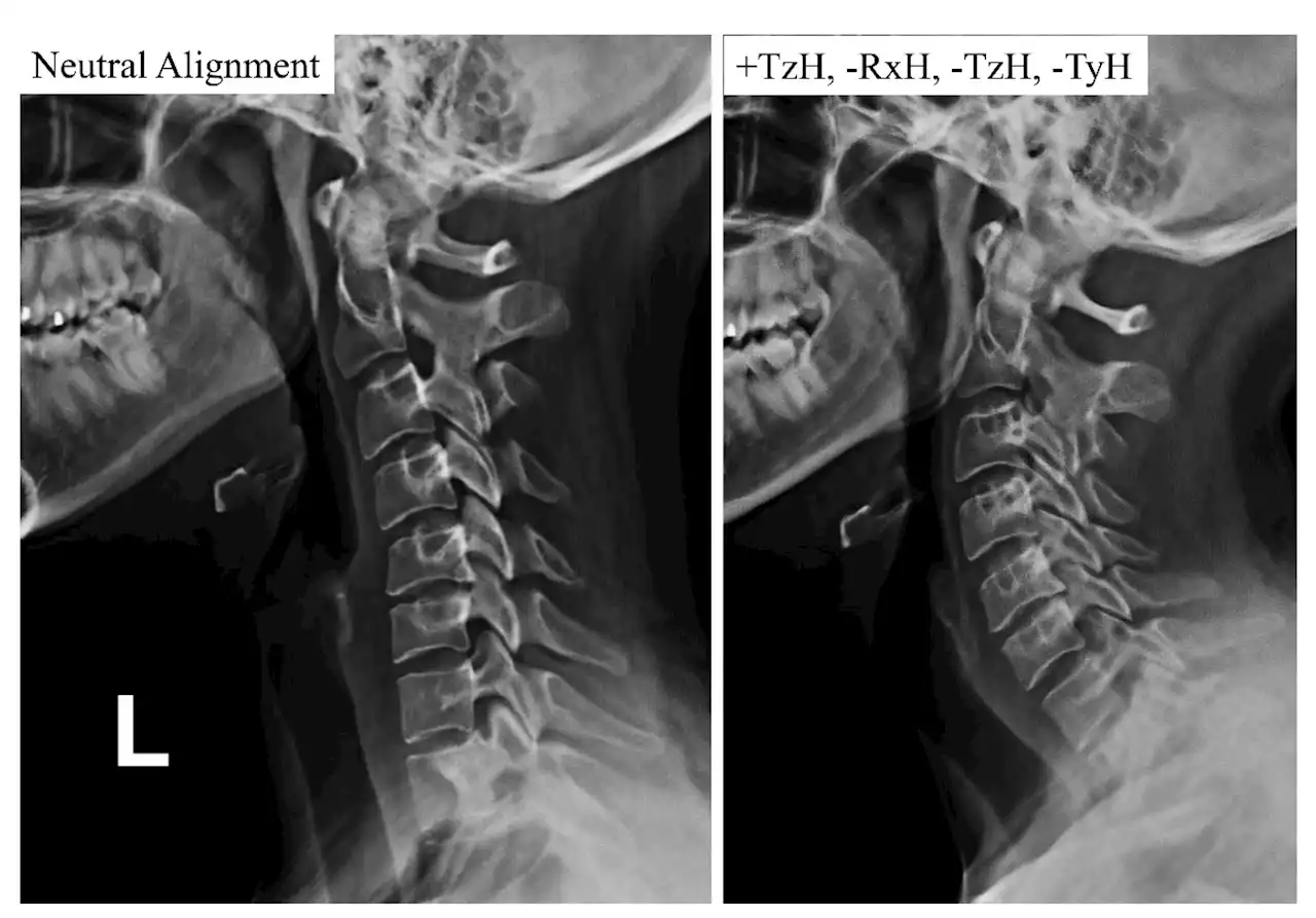 Scientists give elderly chronic neck pain sufferers new hope