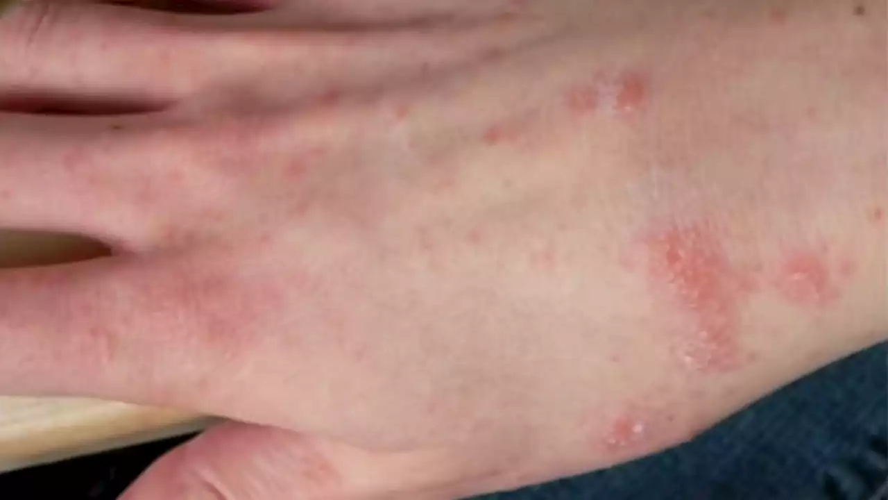 Northwest Side CPD station closed for deep cleaning after case of scabies reported