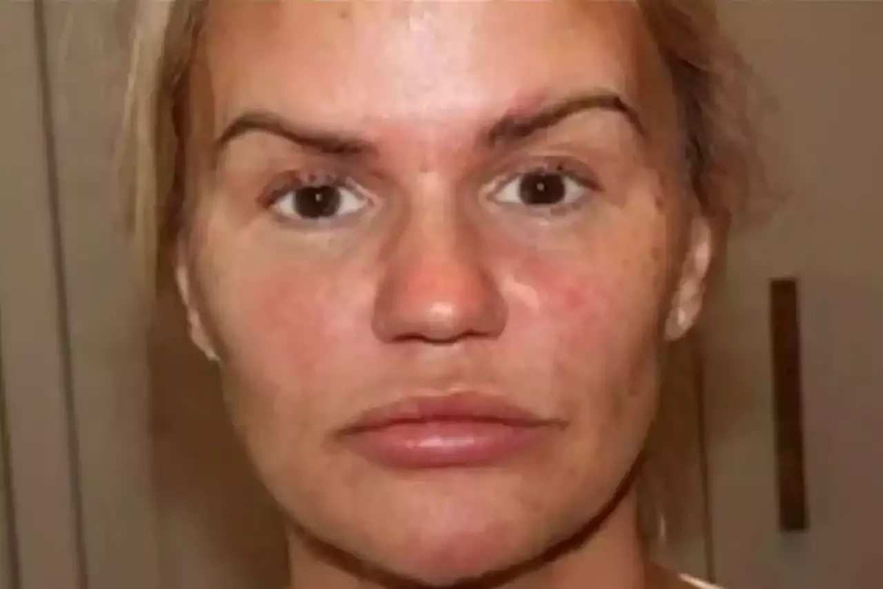 Kerry Katona Reveals Dramatic Results of New Facelift