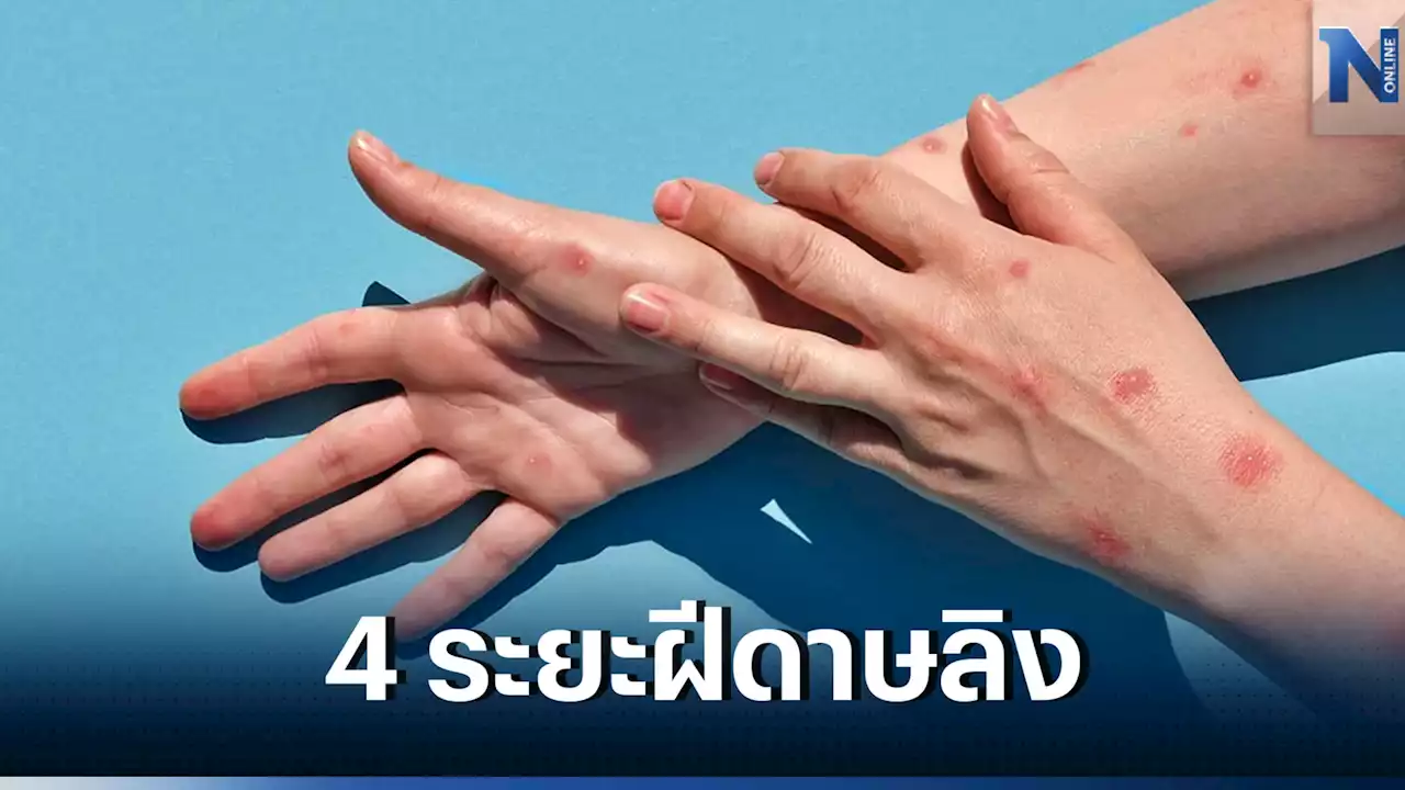 4 ระยะอาการของ ‘โรคฝีดาษลิง’ ตั้งแต่ติดเชื้อจนถึงหายจากโรค