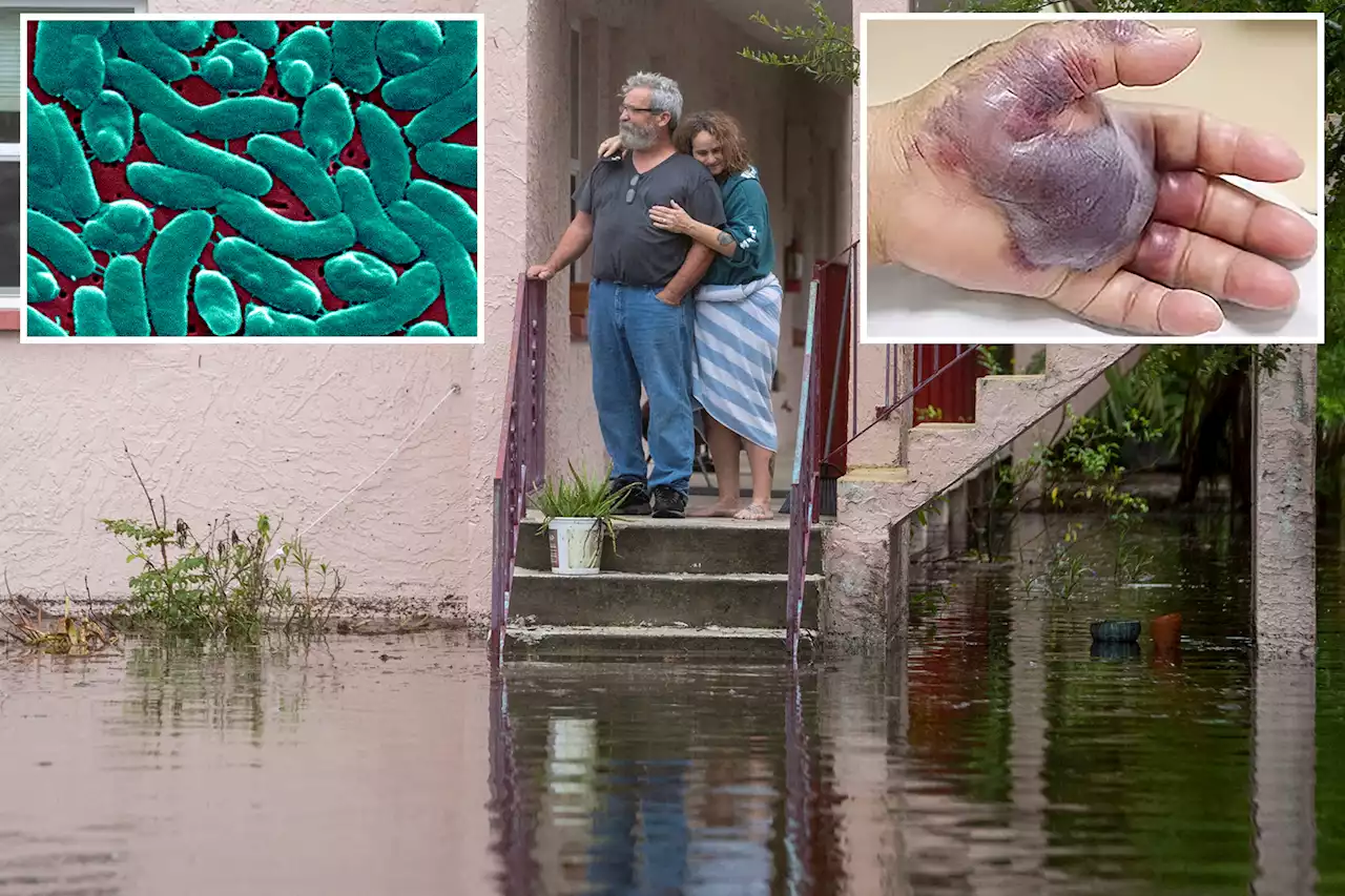 Beware flesh-eating bacteria in Hurricane Idalia floodwaters, officials warn