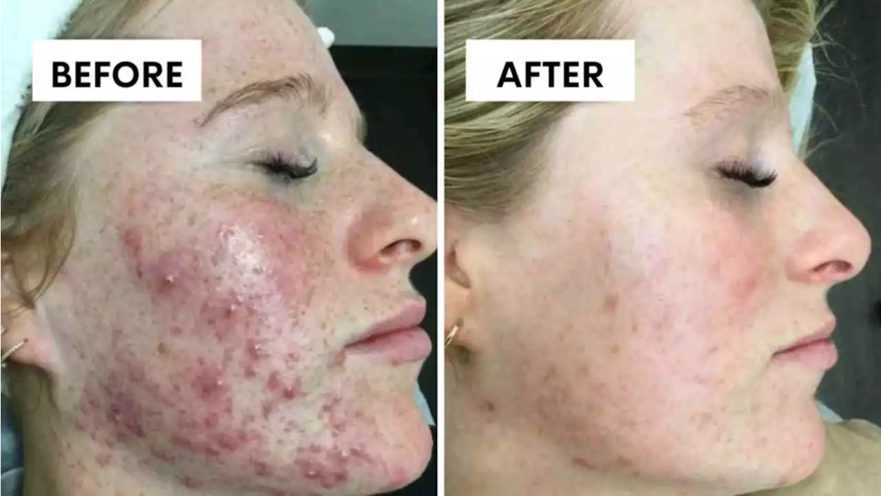 Aussies share results after trying ‘amazing’ facial: ‘I’ve noticed a big difference’