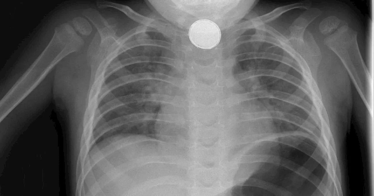 HSE and GP apologize for delayed treatment of child who swallowed battery