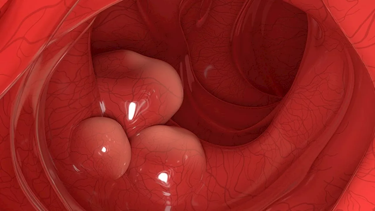 True Benefit of Screening Colonoscopy for CRC Underestimated in NordICC