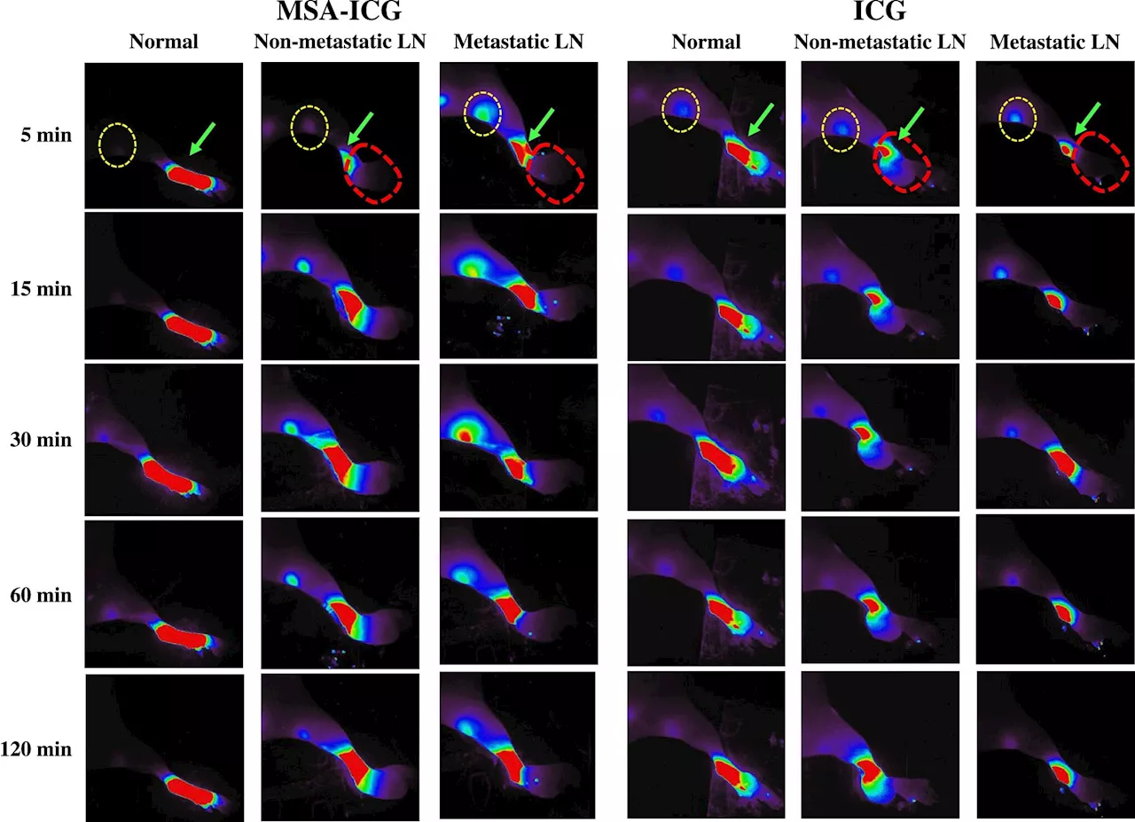 Researchers develop precision surgical technique for lymph node removal in endometrial cancer