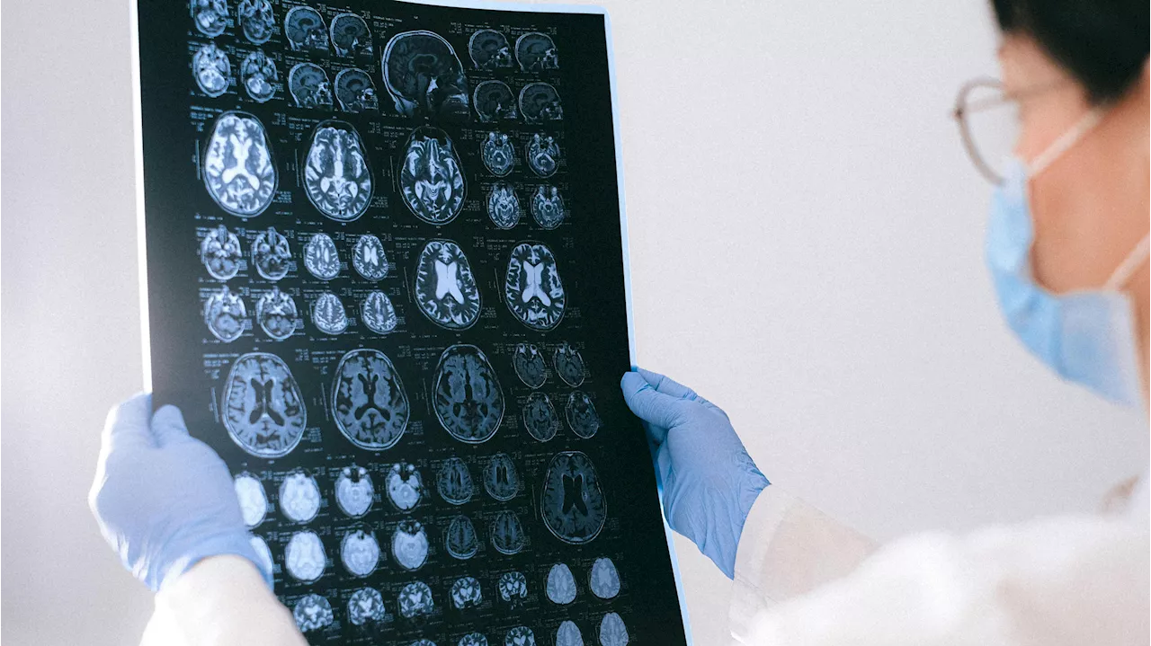 Desarrollan 'minicerebros' para explorar la aparición del alzhéimer