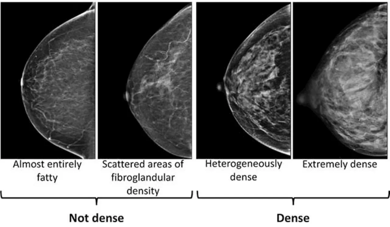 New US Rule Requires Mammography Centers To Inform Women About Breast ...