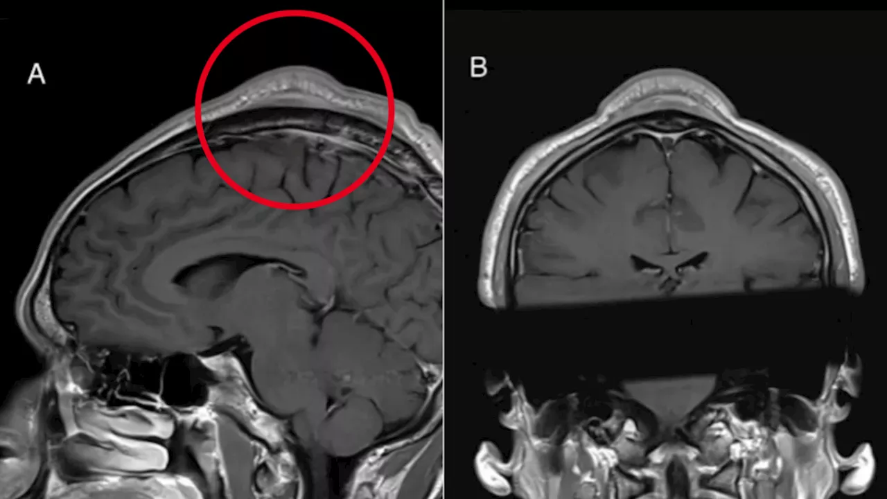 Breakdancing's Headspin Can Cause Benign Tumors