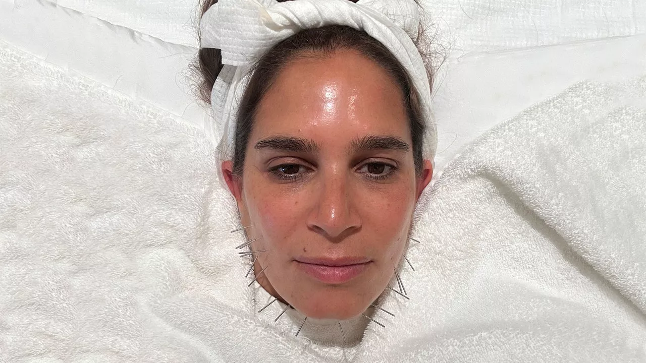 Acuskinlift Review: I Tried The Non-Surgical Facelift & These Were The Results