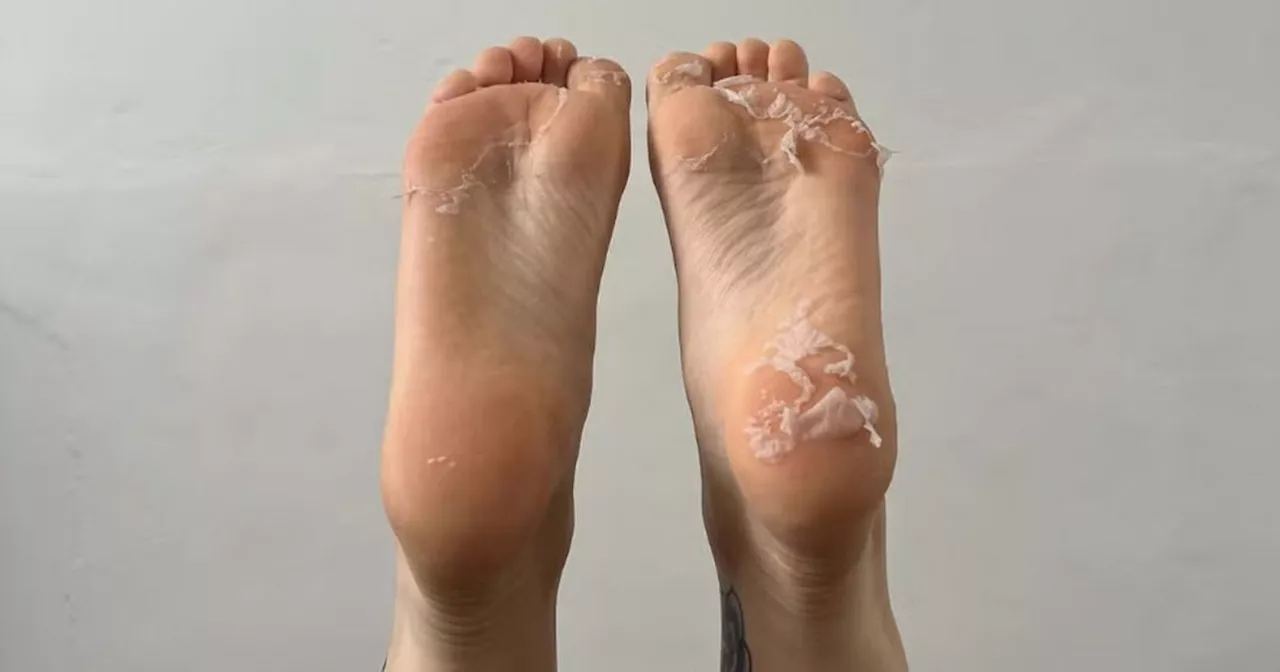 Cracked skin on heels peels off leaving ‘brand new feet’ with €11 foot mask