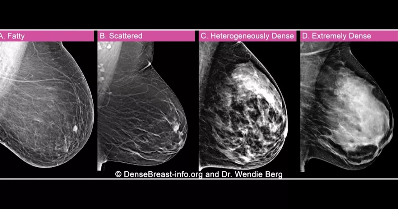 Her breast density camouflaged her cancer. She says new FDA regulations are 'a gift.'