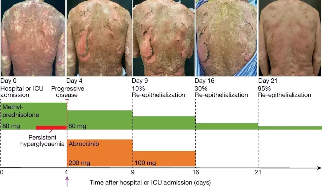 Researchers uncover the potential of JAK inhibitors to treat life-threatening skin disease