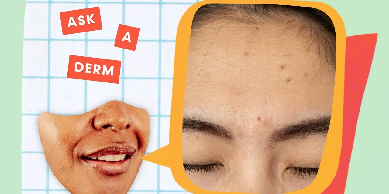 Why Do Pimples Leave Dark Spots—Even If You Don’t Pop Them? We Asked a Dermatologist