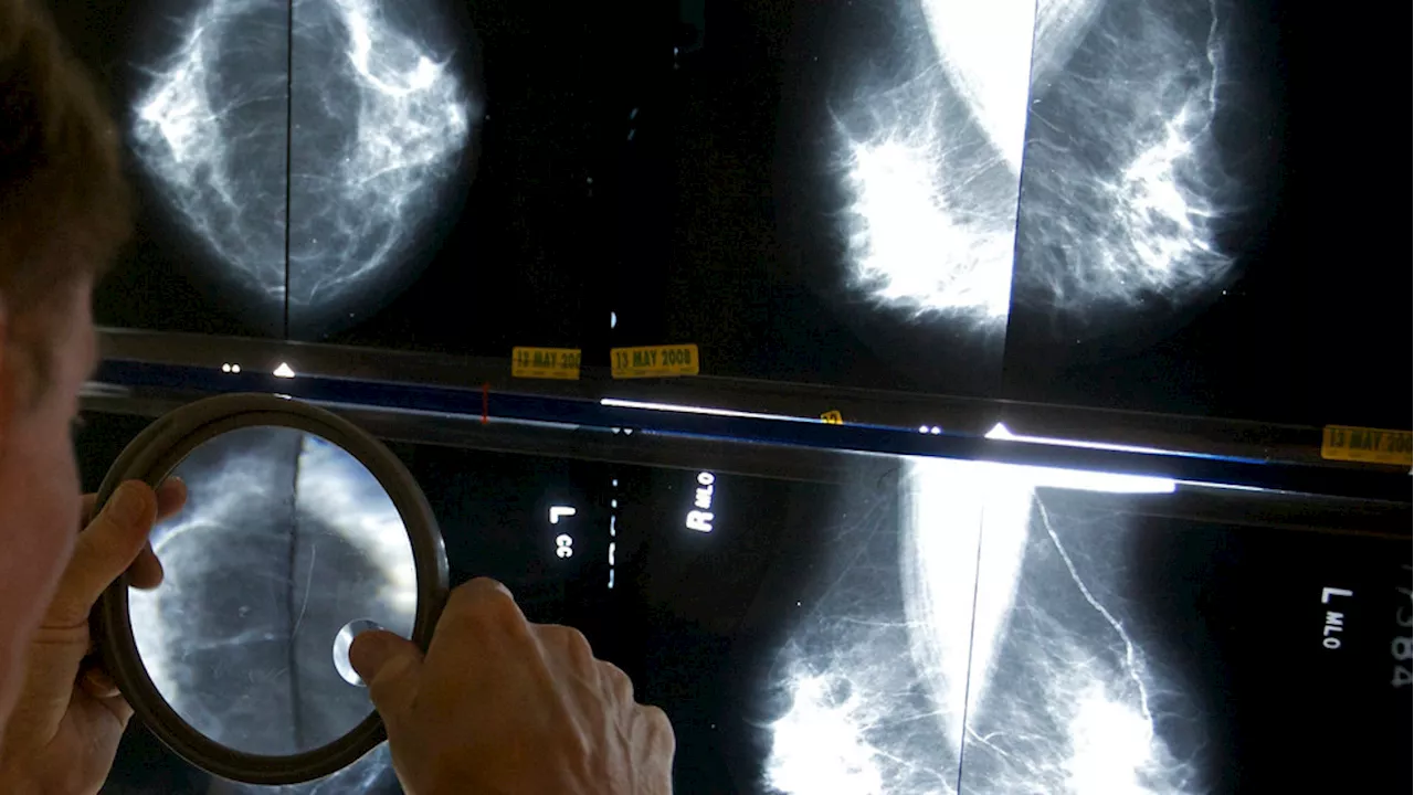 Breast Cancer: Gains in Mortality Rates But Cases Rise