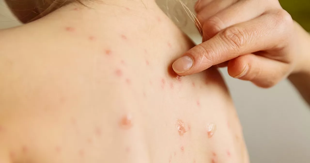 Chickenpox vaccine to be offered to babies at 12 months