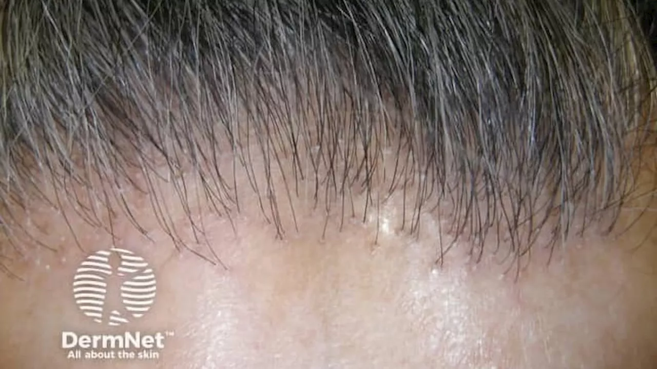 Delgocitinib Cream Shows Promise in Treating Follicular Frontal Alopecia