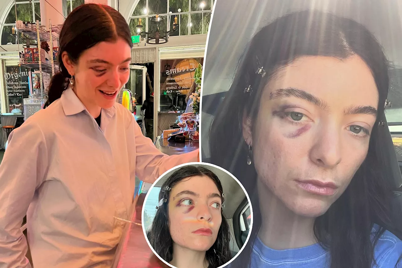 Lorde shares cryptic post with several photos of black eye: 'So concerning'