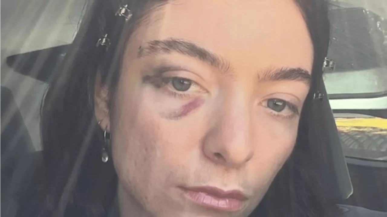 ‘Are you ok?’: Fears for singer Lorde after shocking photos