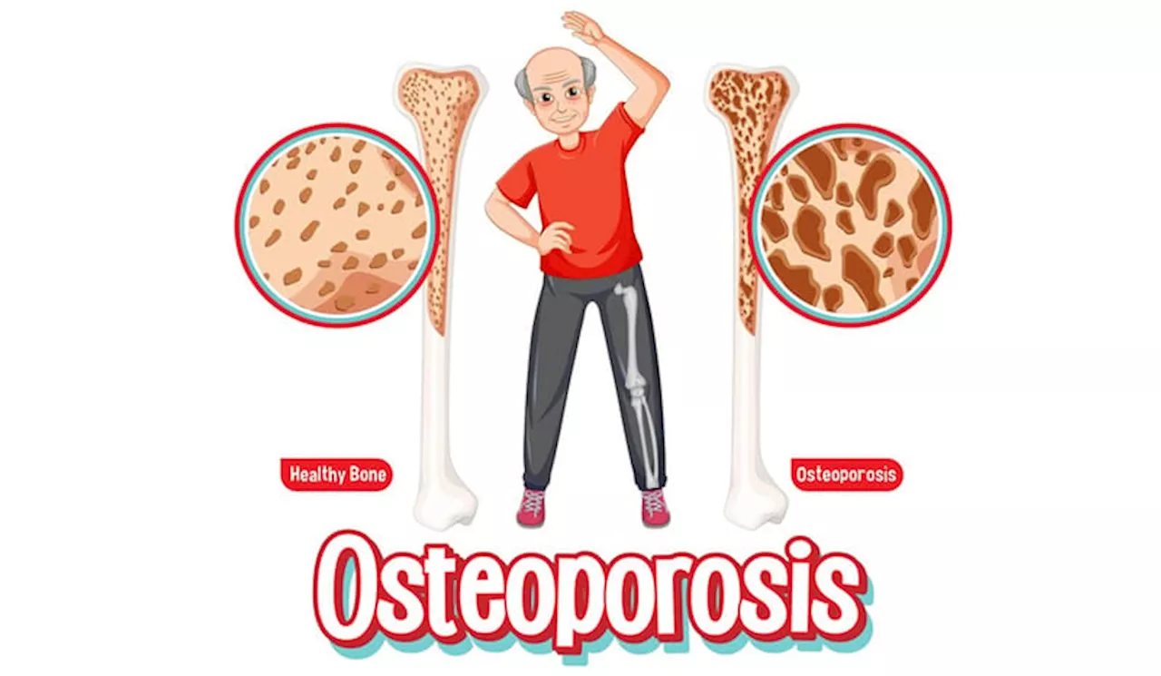 Mitos dan Fakta Seputar Penyakit Osteoporosis