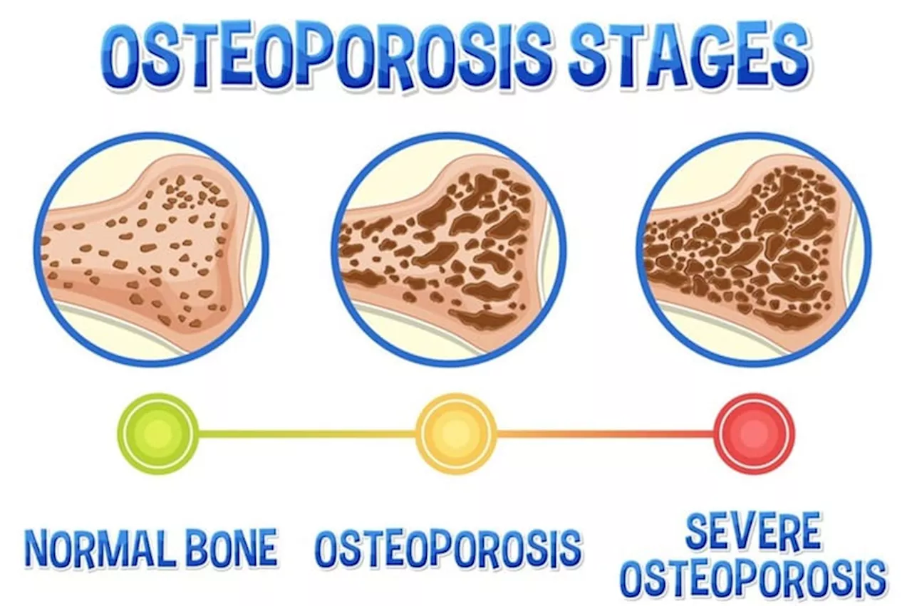 Osteoporosis Pencuri Diam-Diam yang Mengancam Kesehatan Tulang, Kenali Gejala dan Pencegahannya